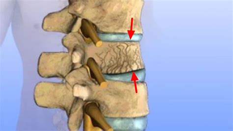 do thoracic compression fractures heal